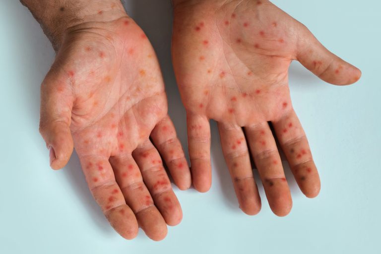 Mpox Disease Under Control In South Africa